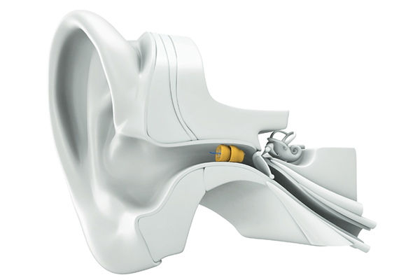 Lyric Hearing Aid
